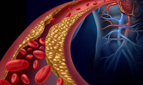 علامات على جسمك تدل على ارتفاع نسبة الكولسترول في الدم